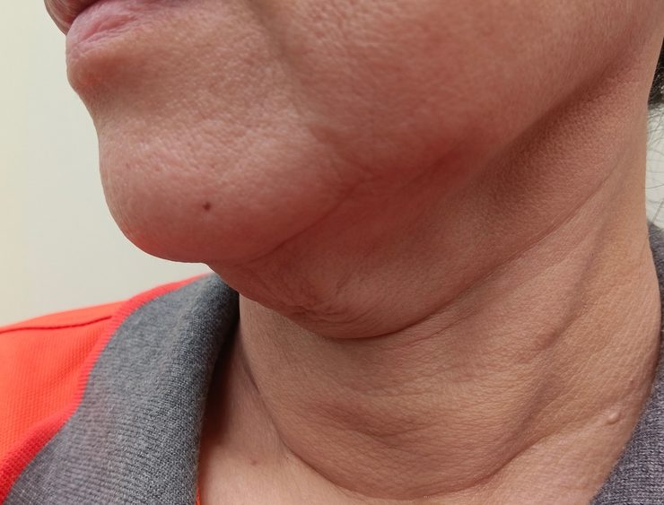 How Much Is Neck Lift Surgery in McLean