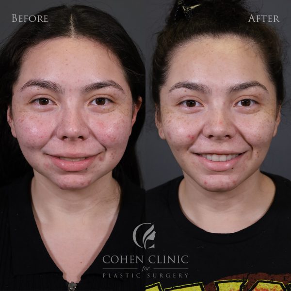 0018 Chin Implant Full Face_Smile