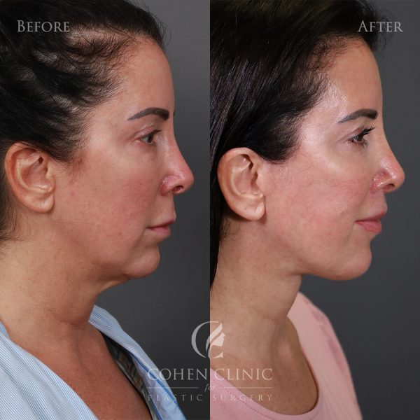 Case 32639 Marge Image