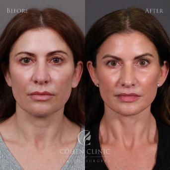 Facelift / Neck-lift