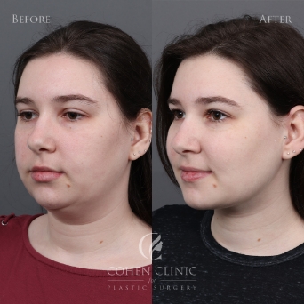 Face / Neck Contouring