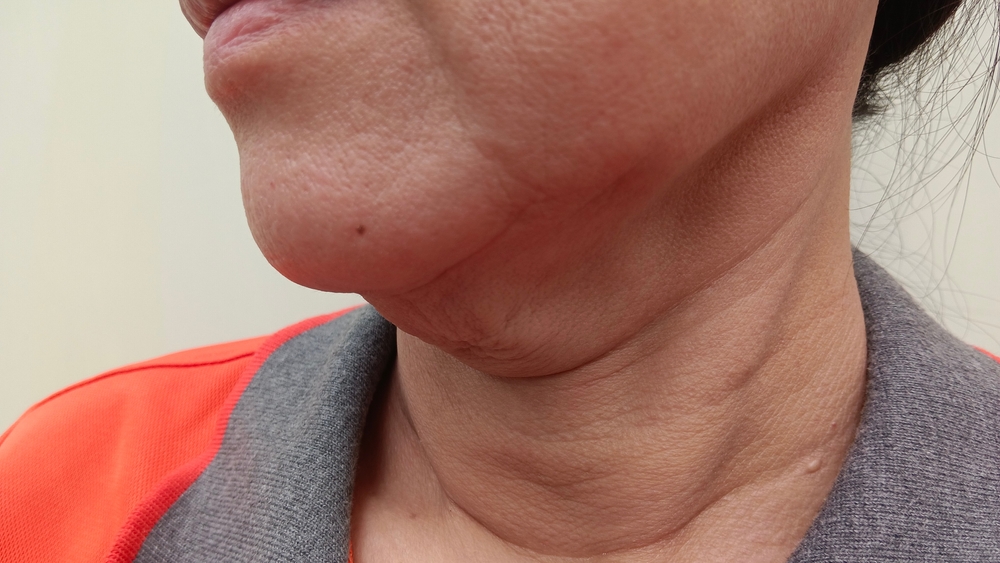 How Much Is Neck Lift Surgery in McLean, Virginia?