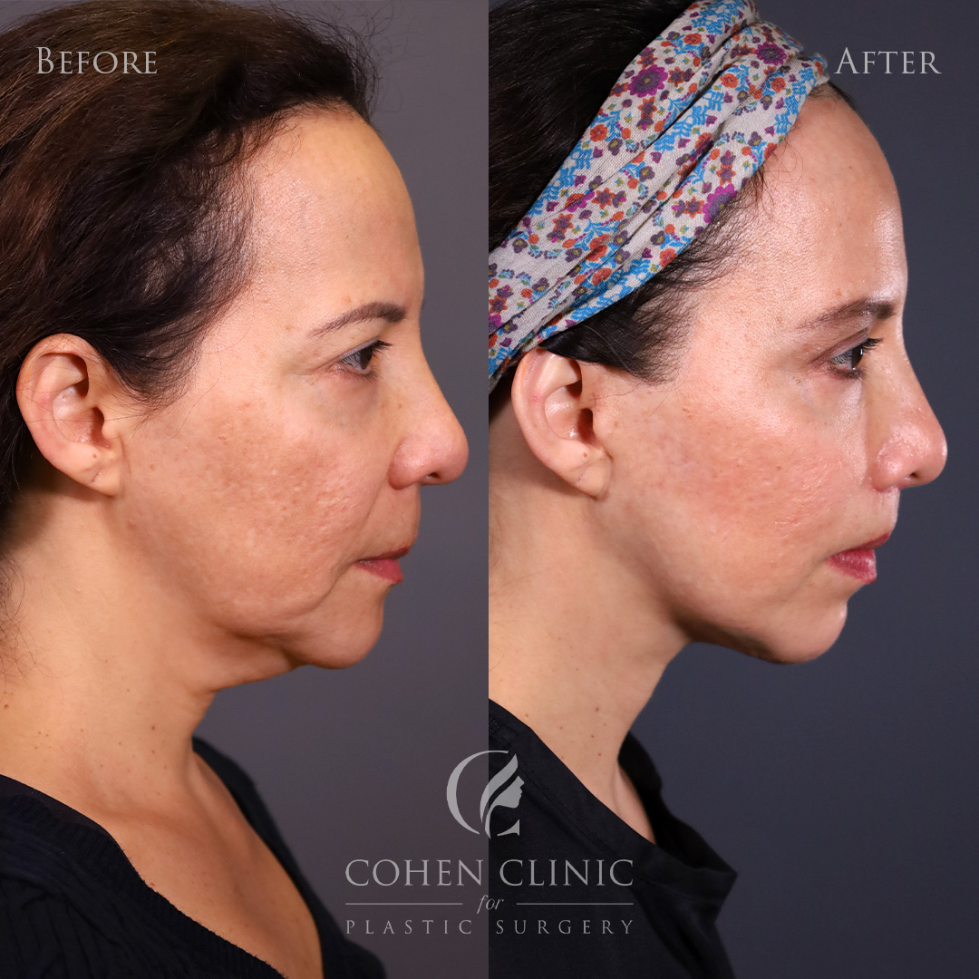 Case 34555 Marge Image