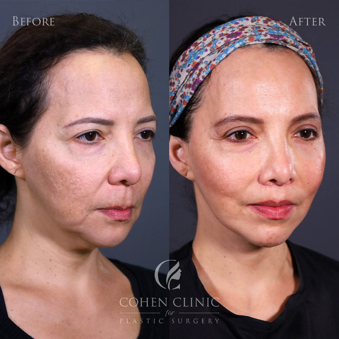 Case 34555 Marge Image