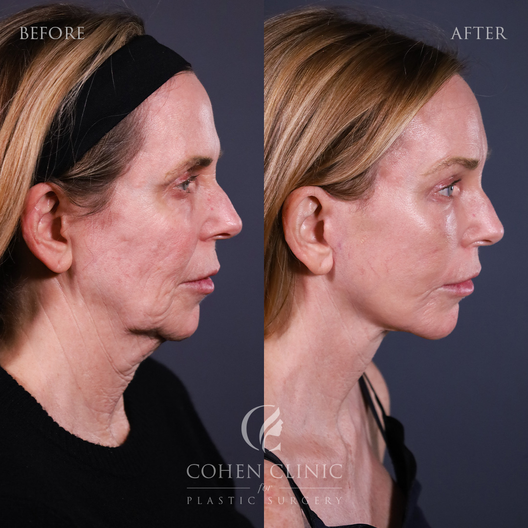 Case 18235 Marge Image