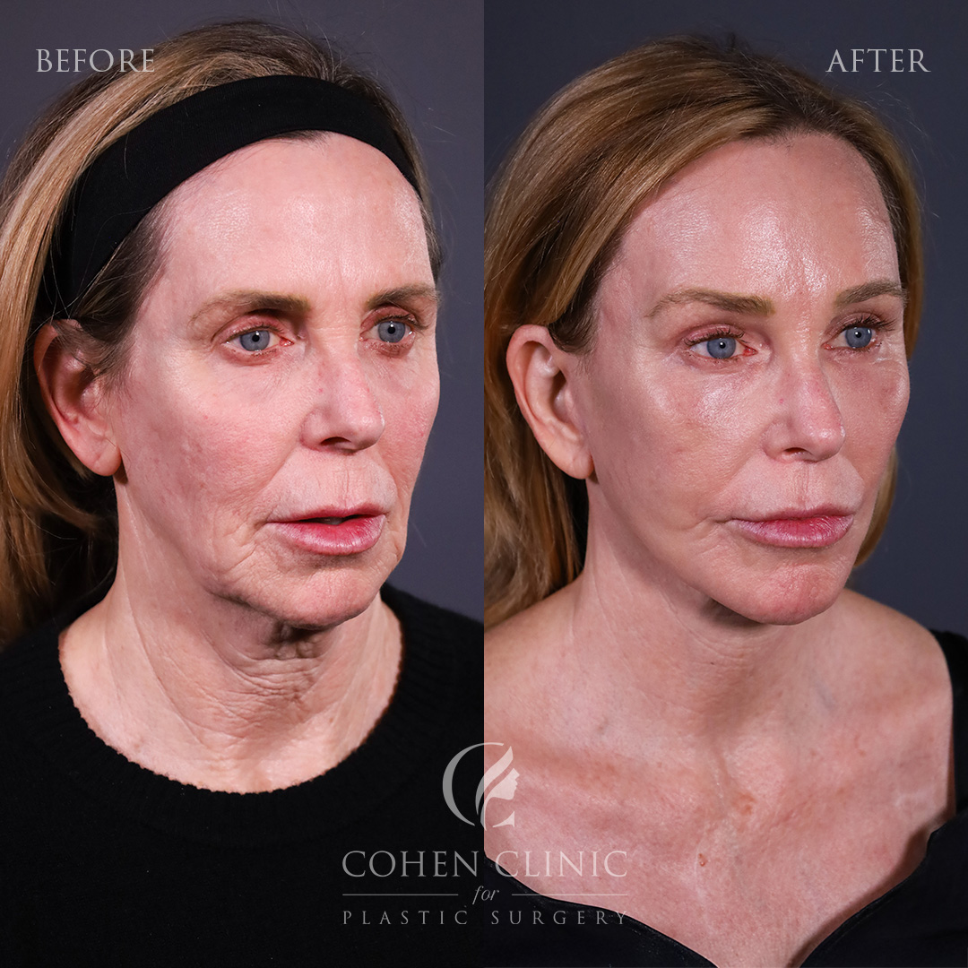 Case 18235 Marge Image