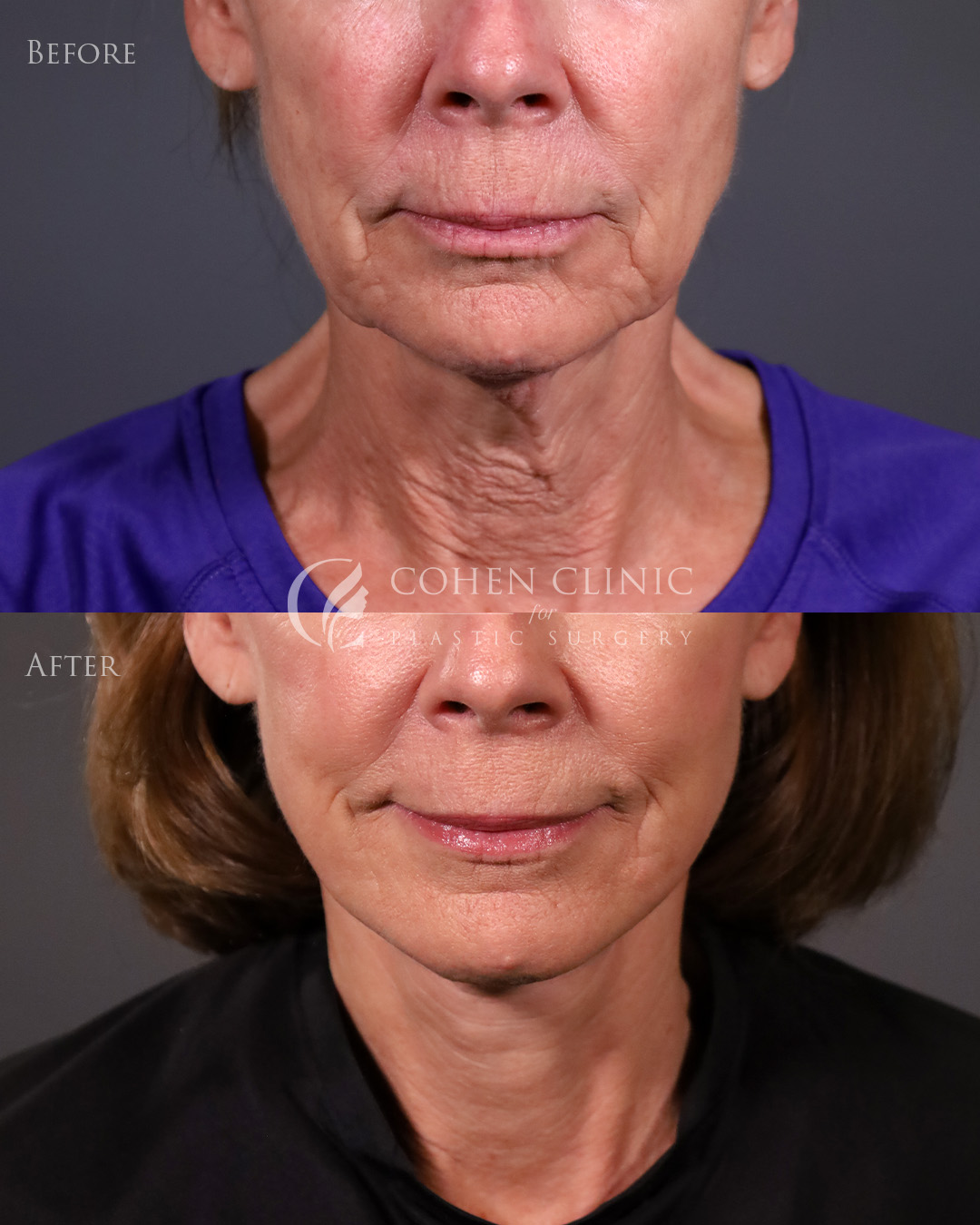 Case 22322 Marge Image