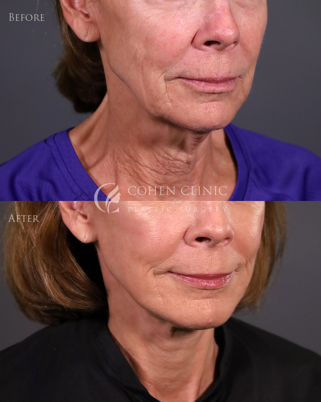 Case 22322 Marge Image