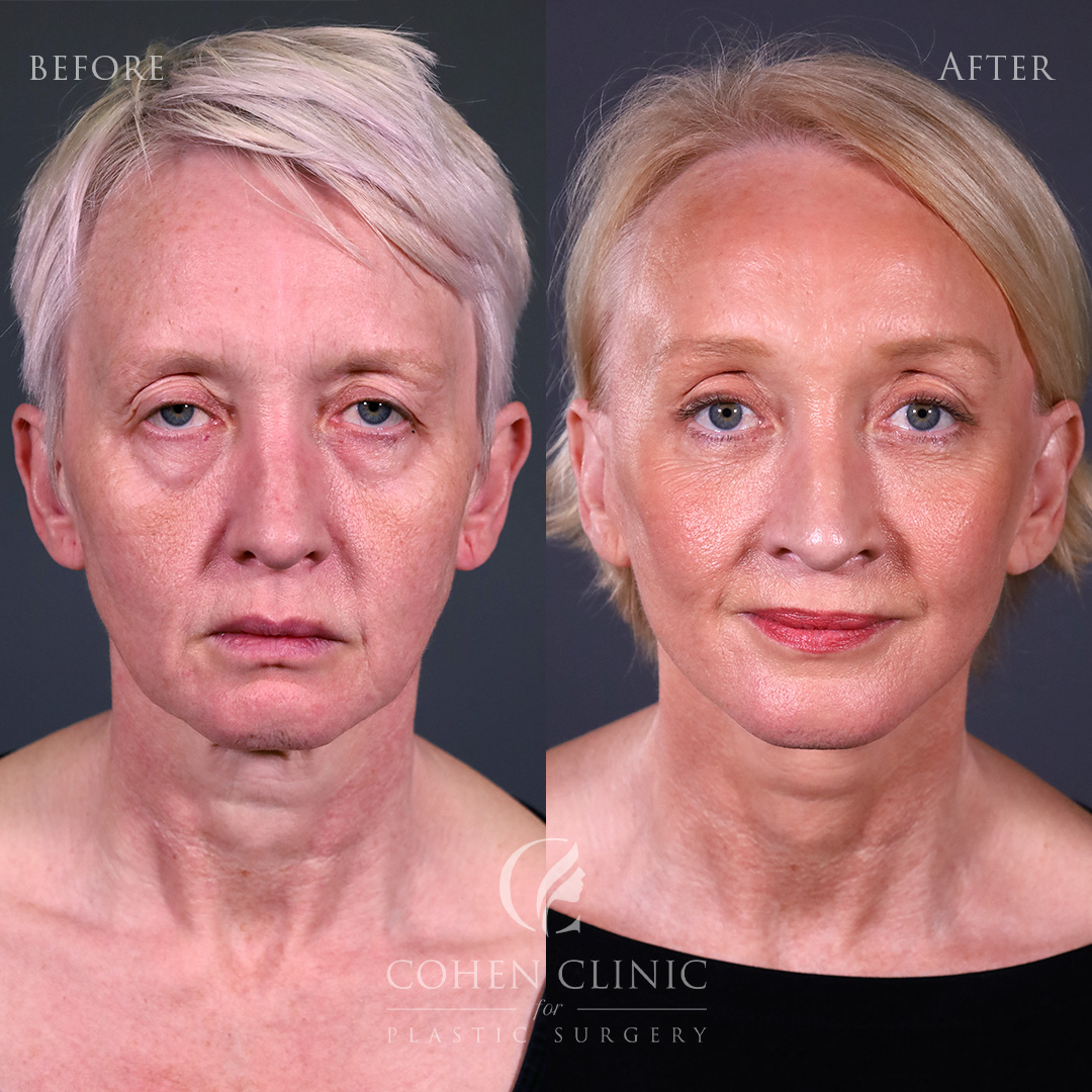 Case 34124 Marge Image