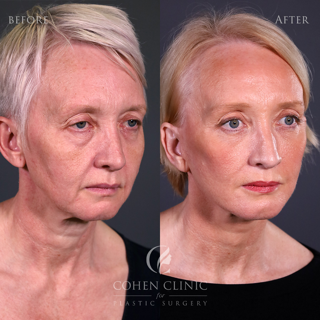 Case 34124 Marge Image