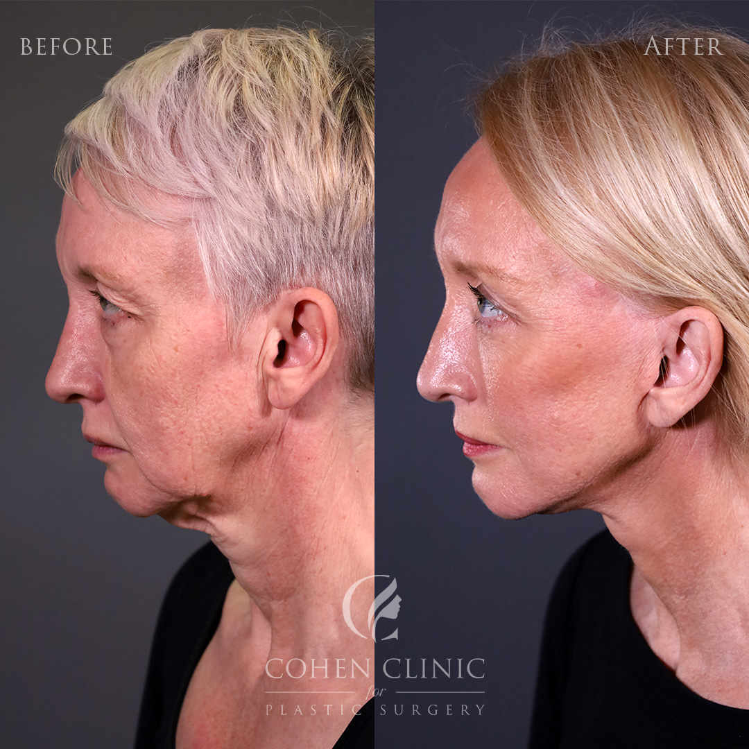 Case 34124 Marge Image