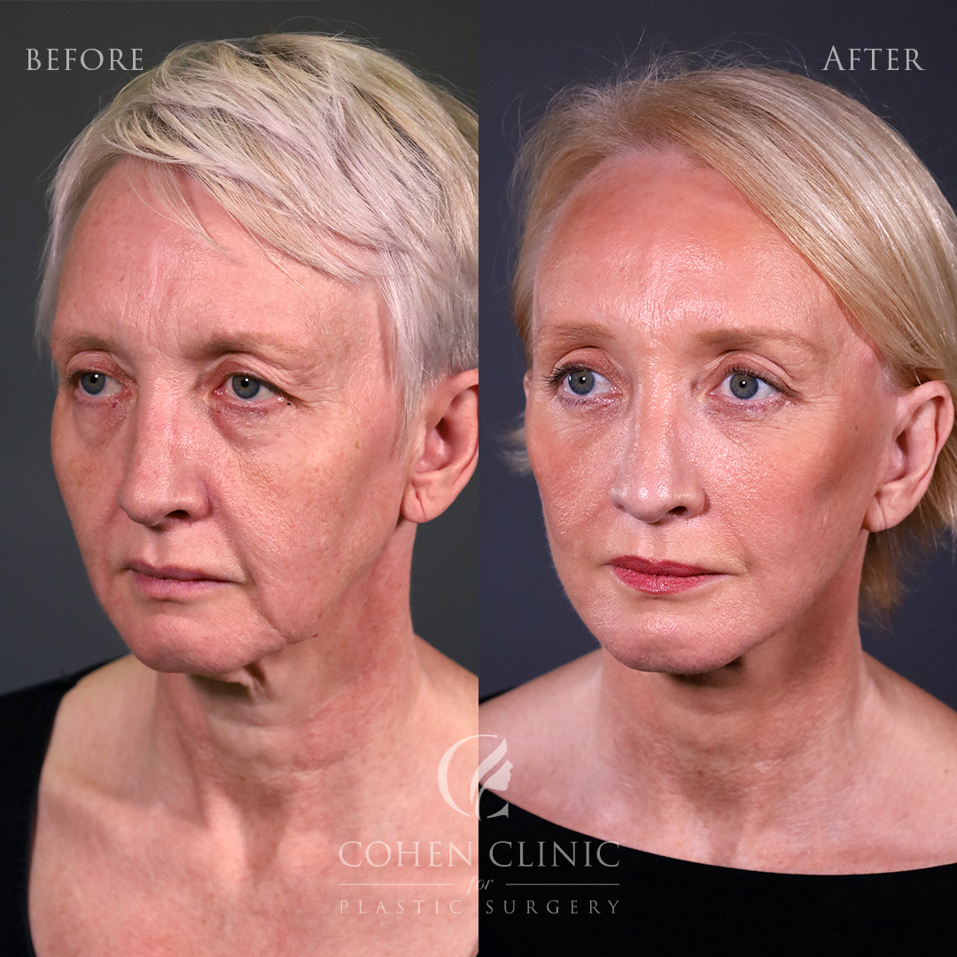 Case 34124 Marge Image