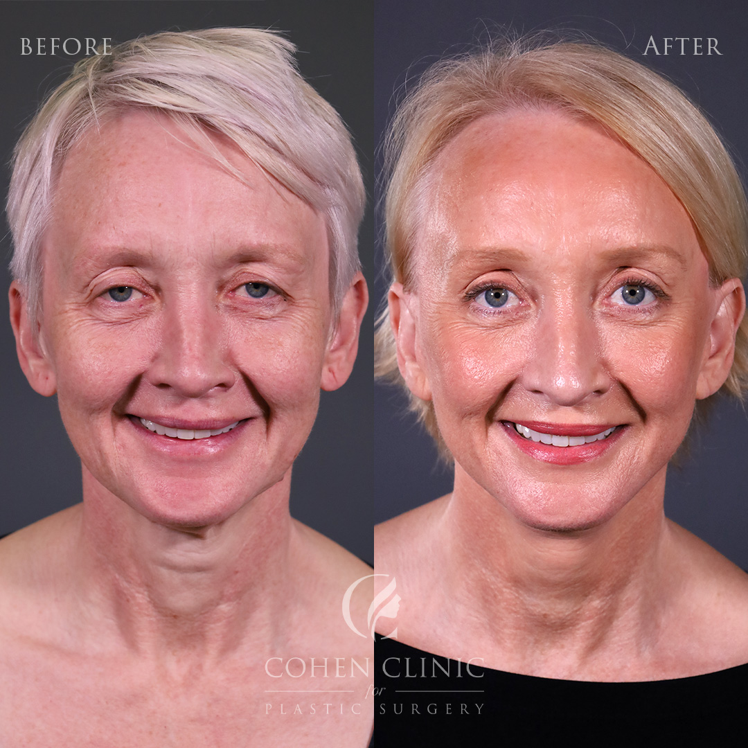 Case 34124 Marge Image