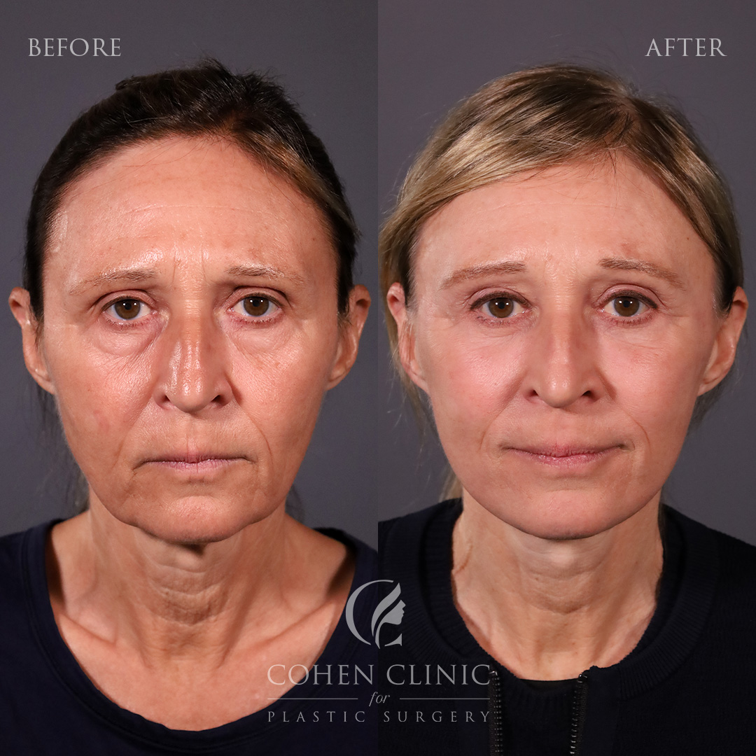 Case 45632 Marge Image