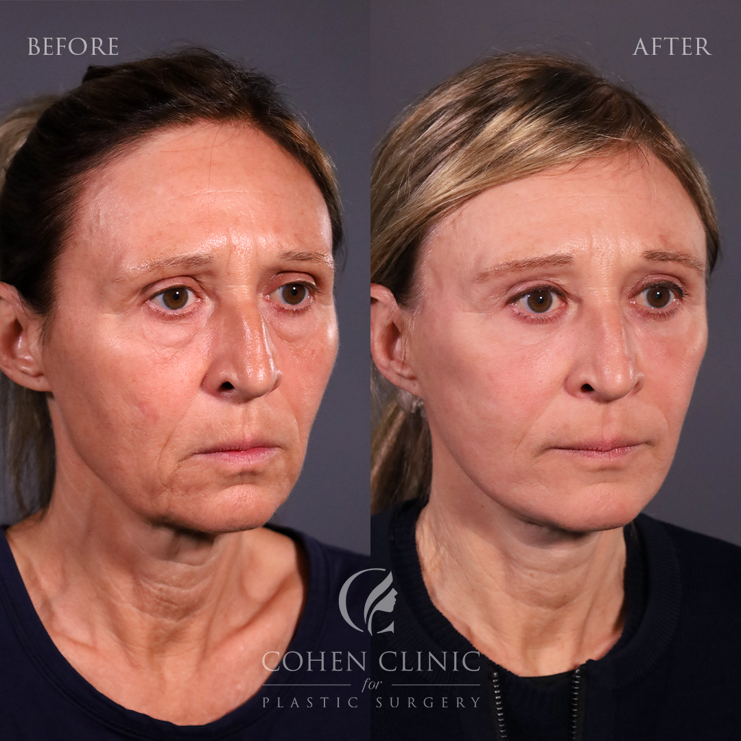 Case 45632 Marge Image