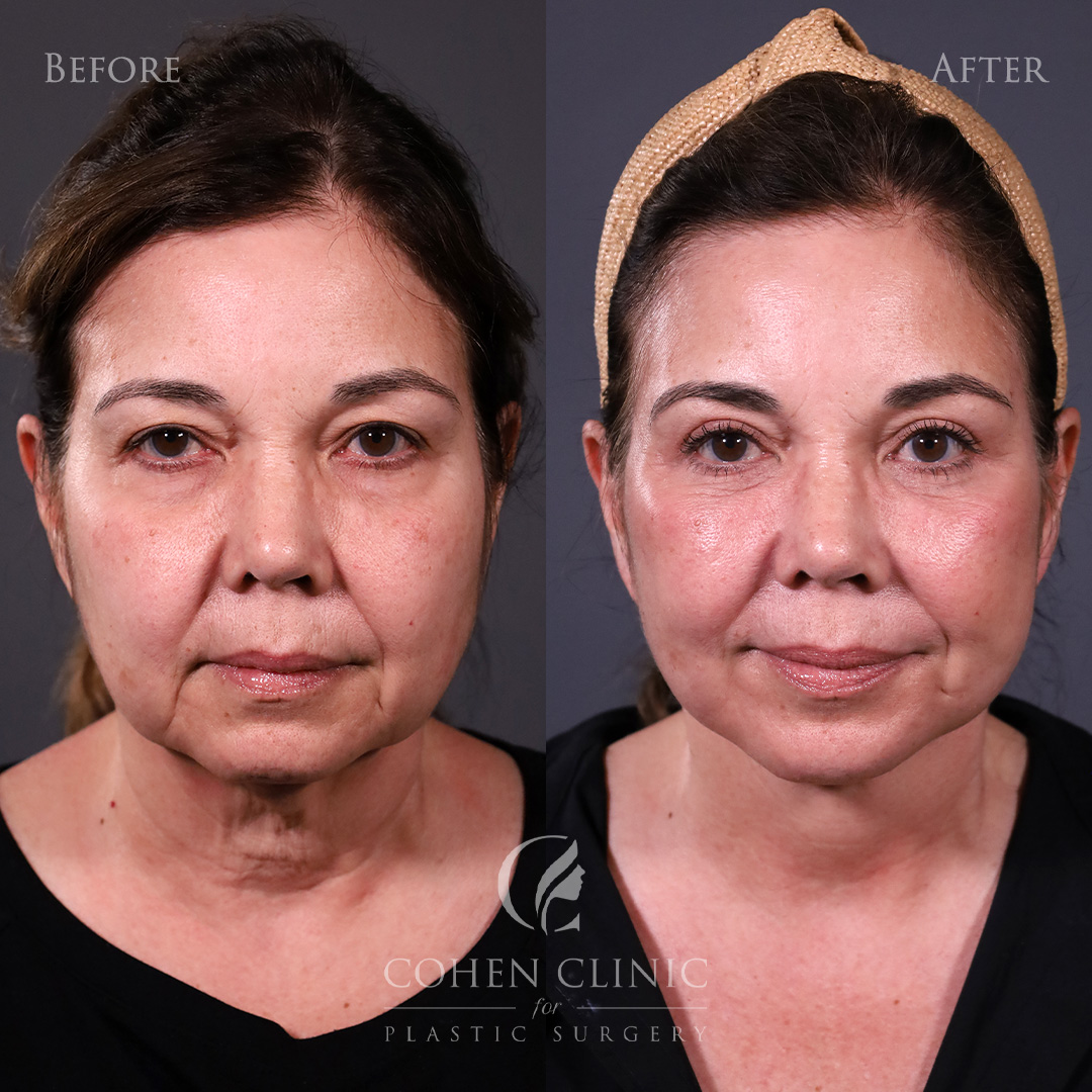 Case 56655 Marge Image