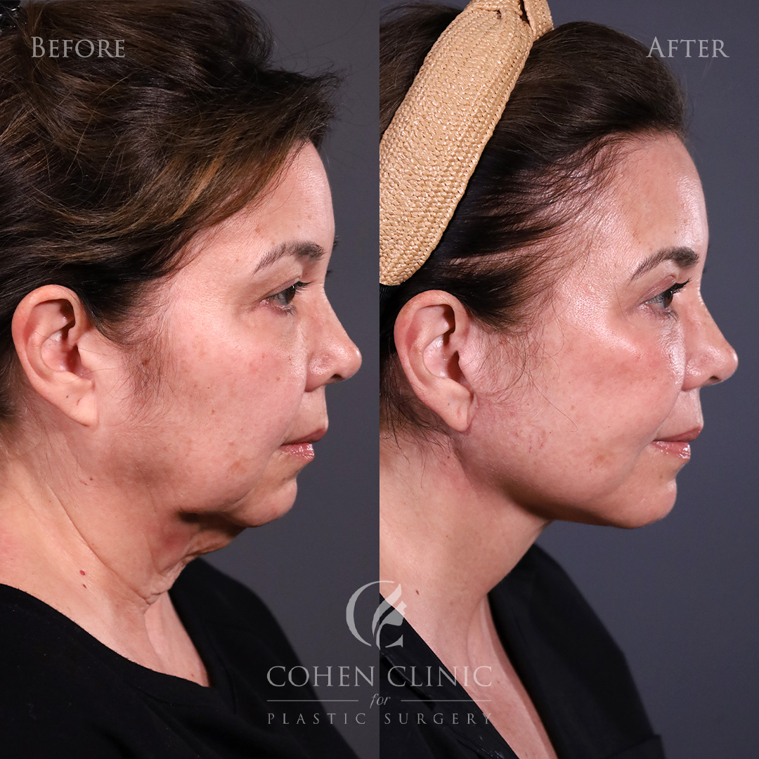 Case 56655 Marge Image