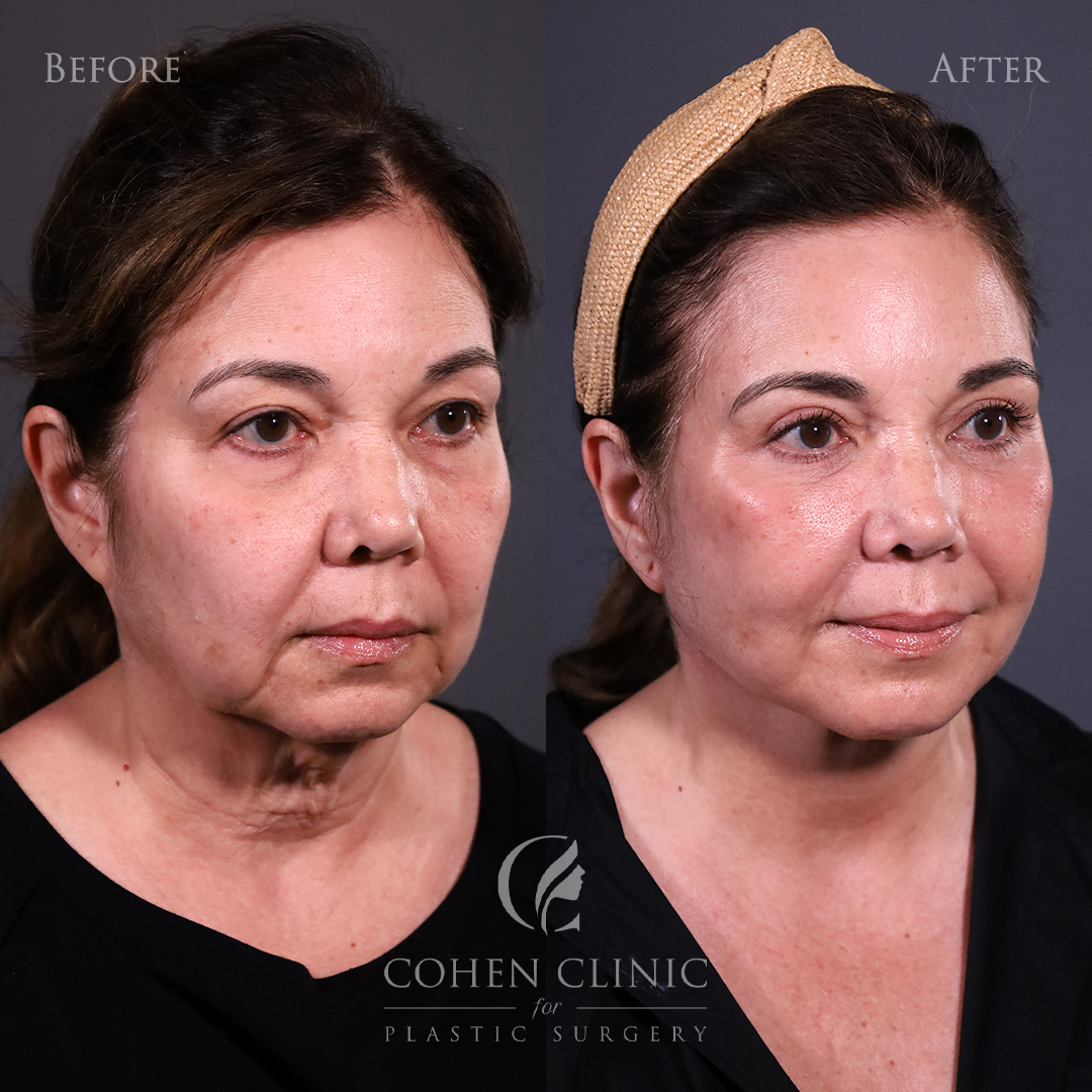 Case 56655 Marge Image