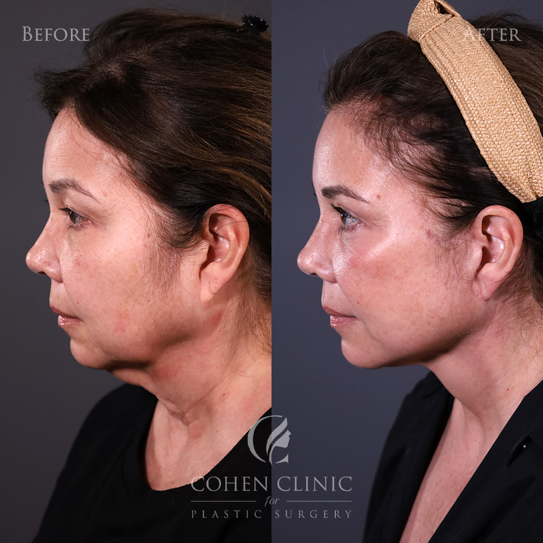 Case 56655 Marge Image