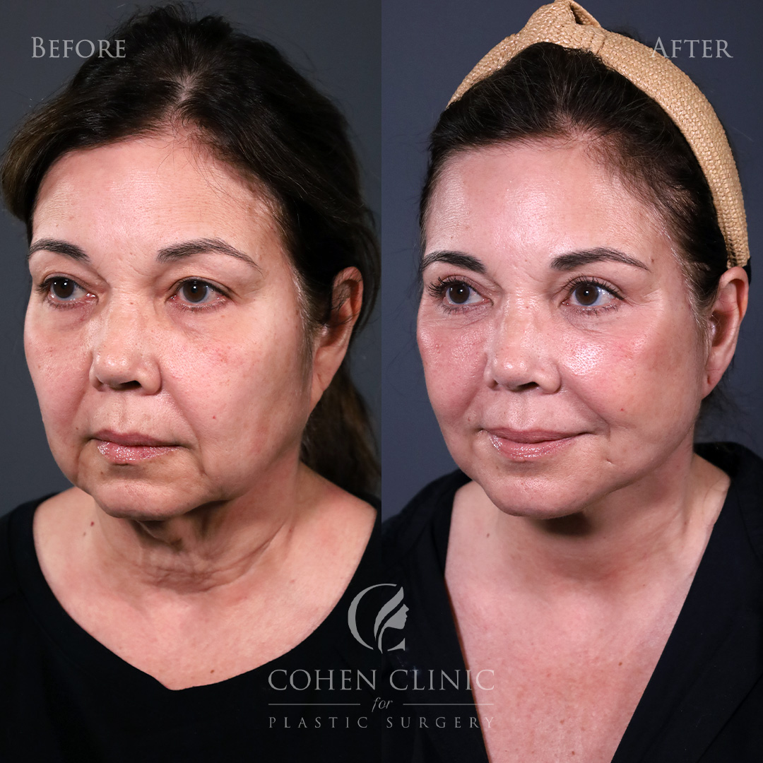 Case 56655 Marge Image