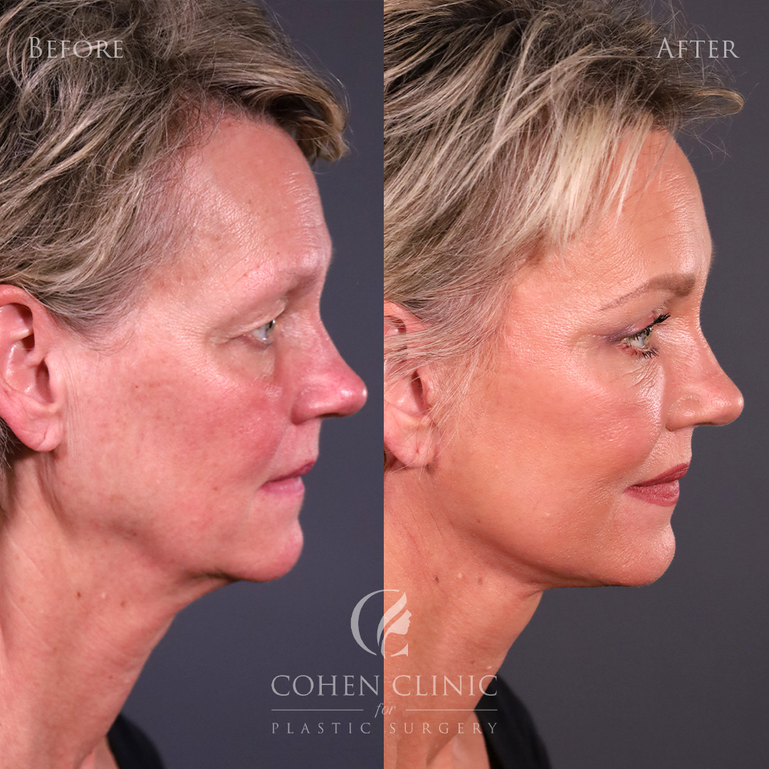 Case 34522 Marge Image