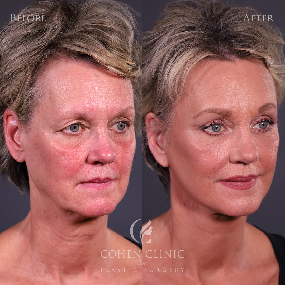 Case 34522 Marge Image