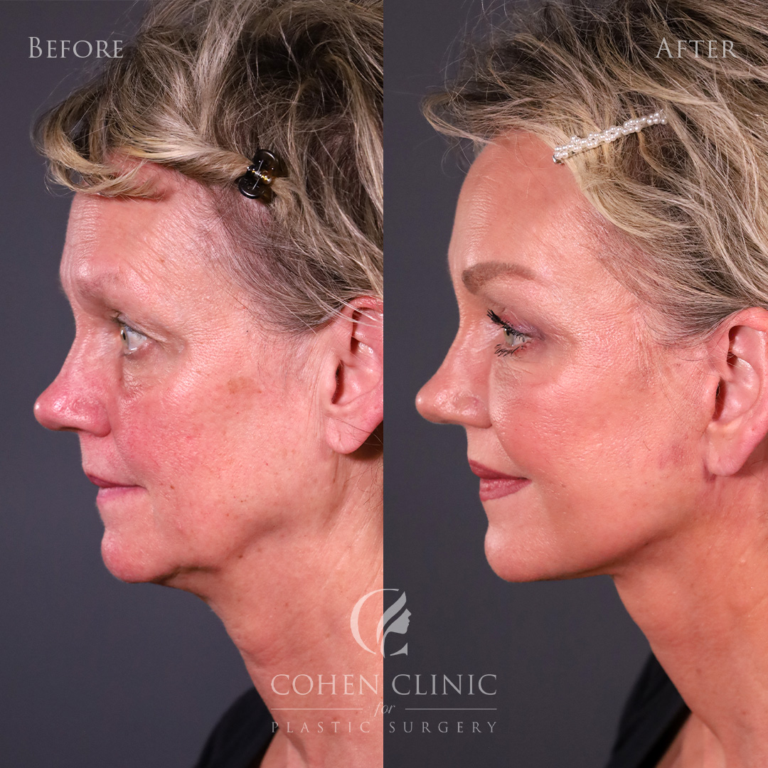 Case 34522 Marge Image