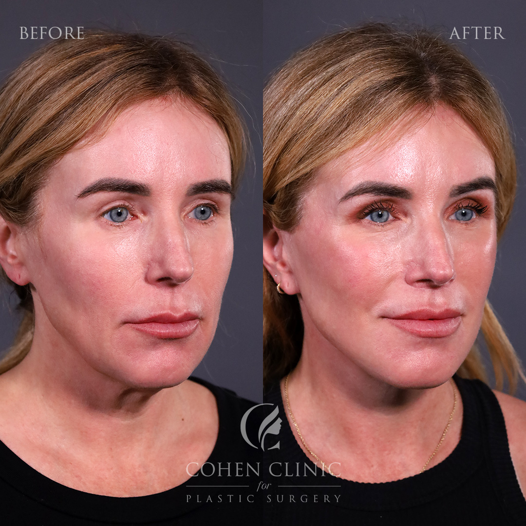 Case 77789 Marge Image