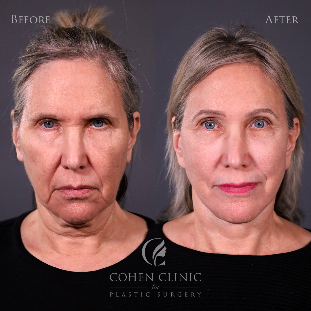 Case 76844 Marge Image