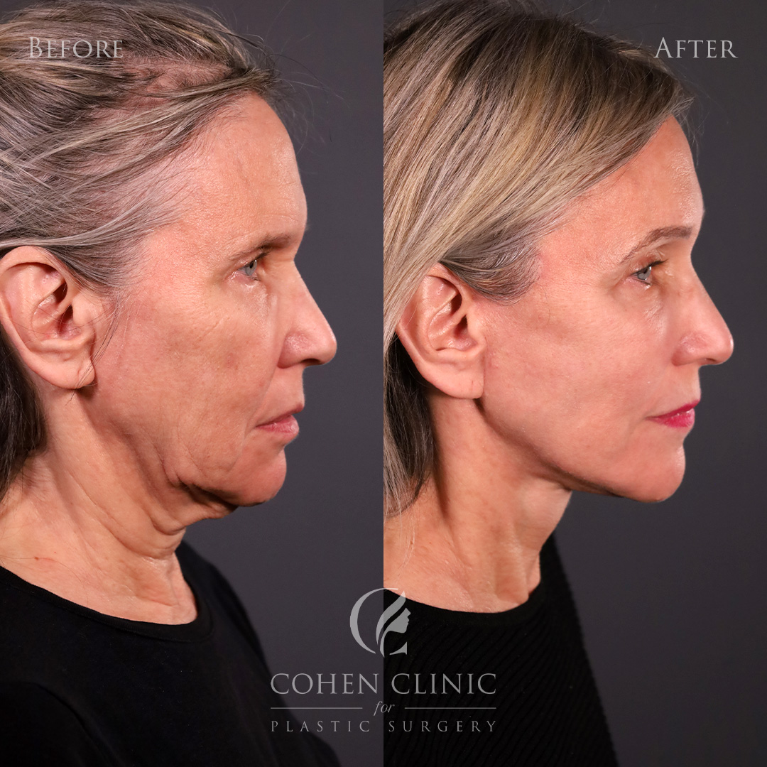 Case 76844 Marge Image