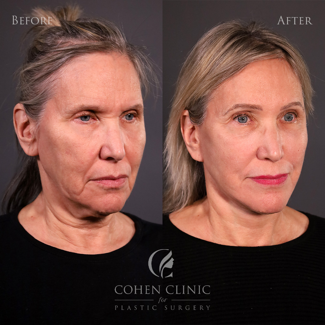 Case 76844 Marge Image