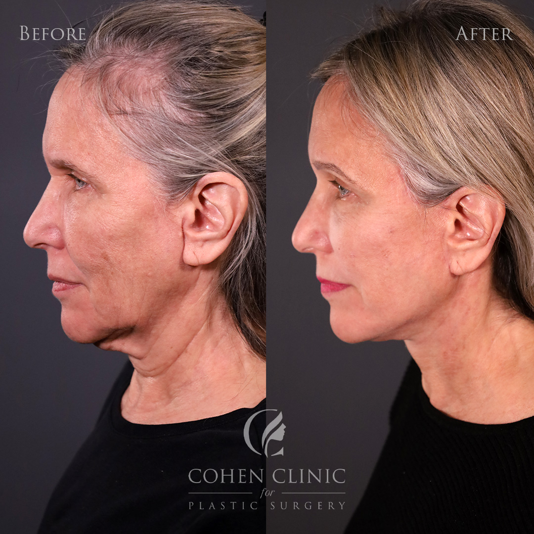 Case 76844 Marge Image