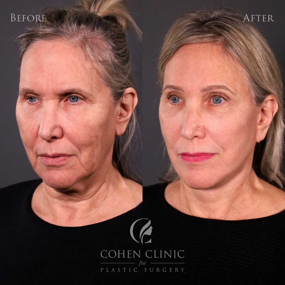 Case 76844 Marge Image