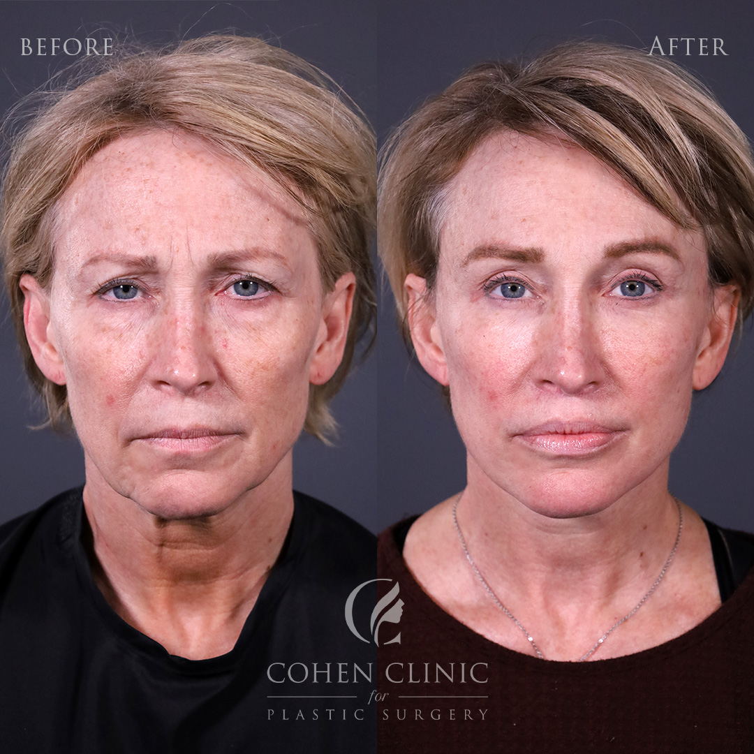 Case 22356 Marge Image