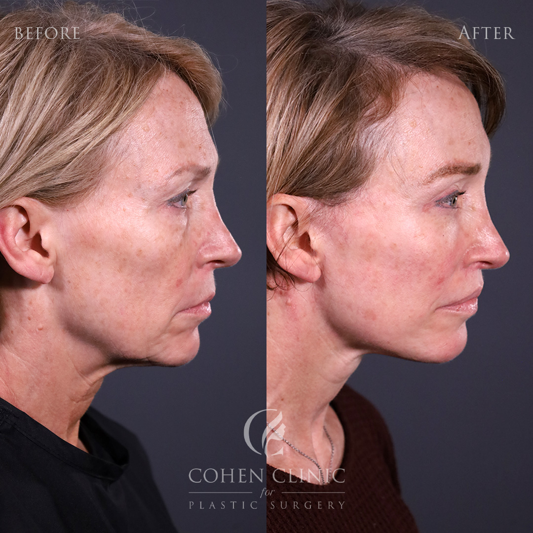 Case 22356 Marge Image