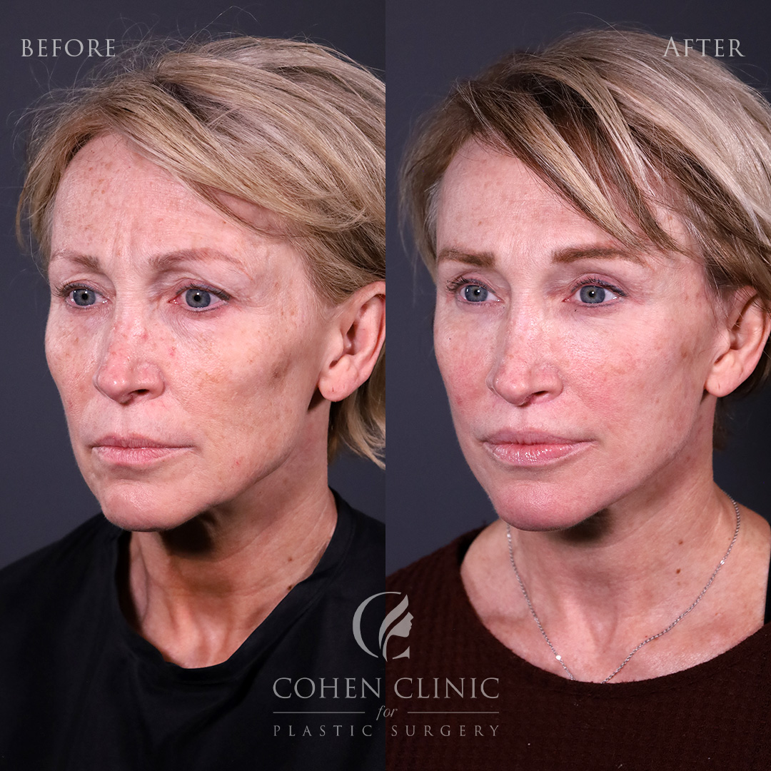 Case 22356 Marge Image