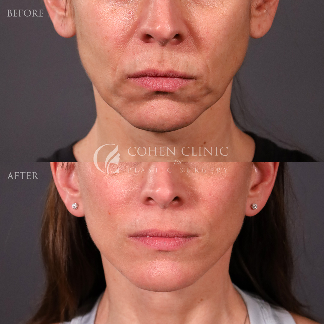 Case 11117 Marge Image