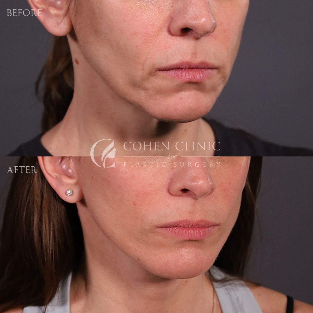 Case 11117 Marge Image