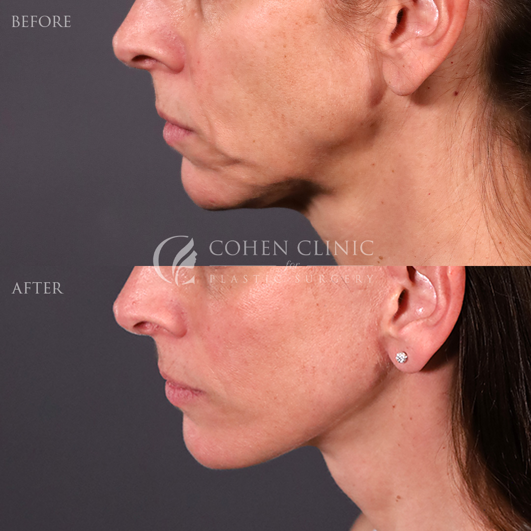 Case 11117 Marge Image