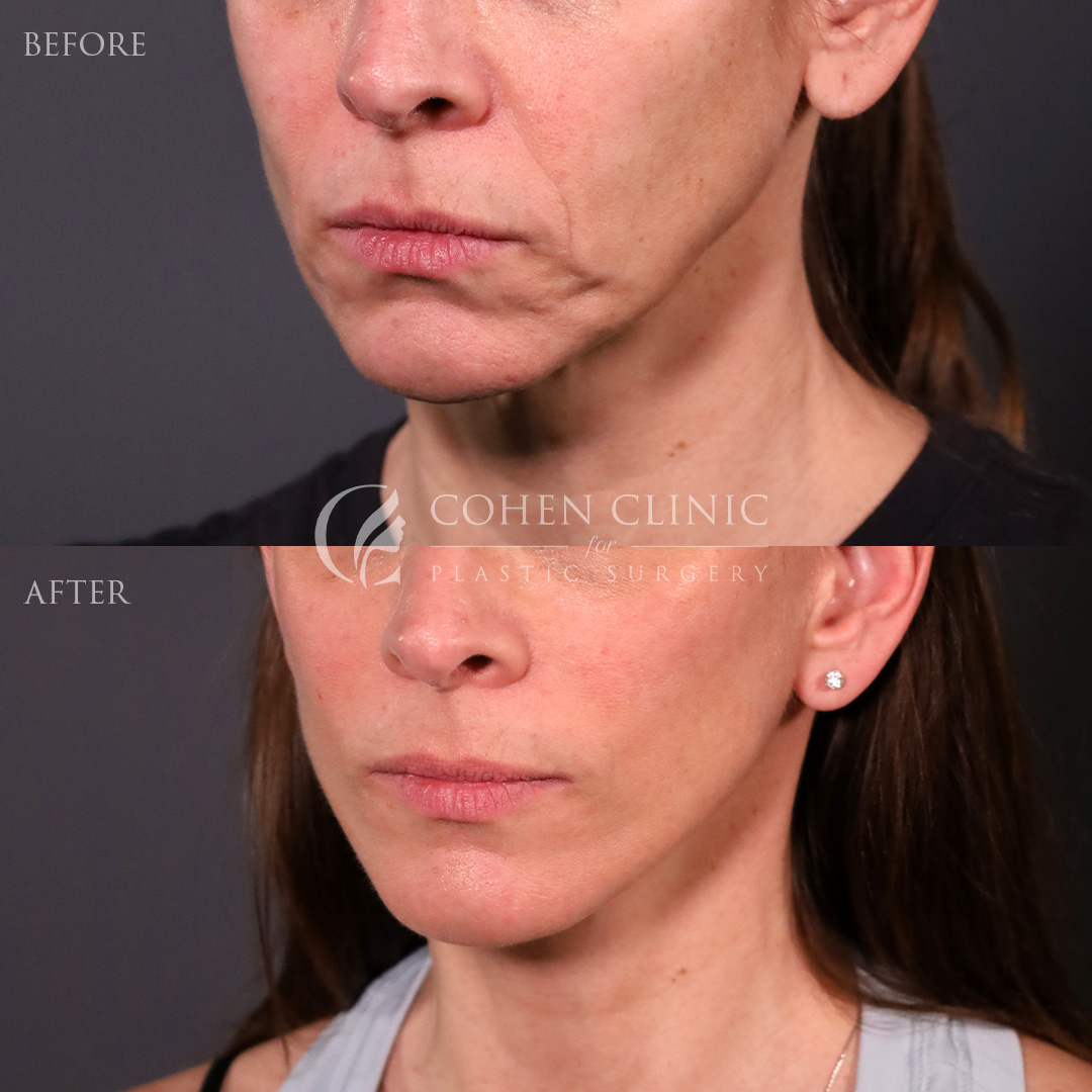 Case 11117 Marge Image