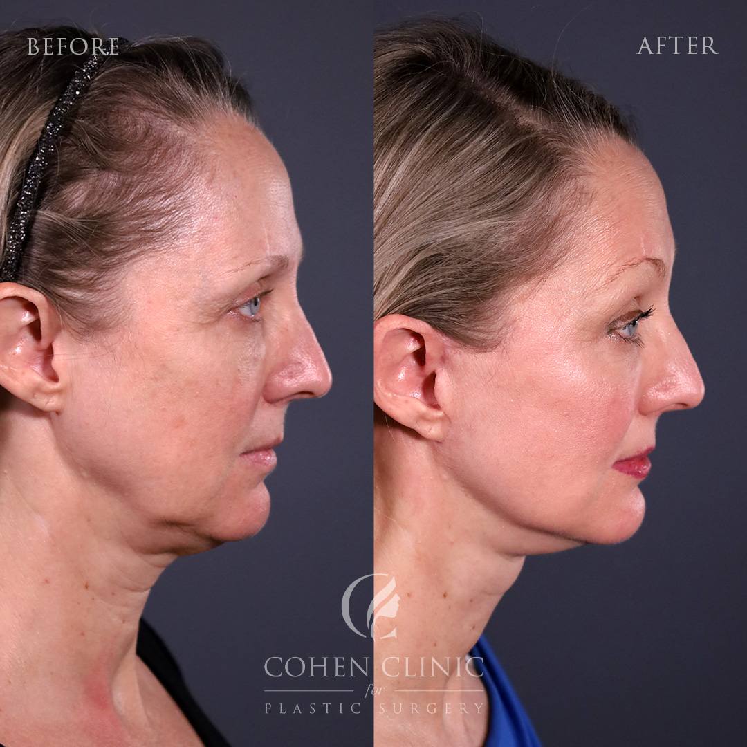 Case 67779 Marge Image