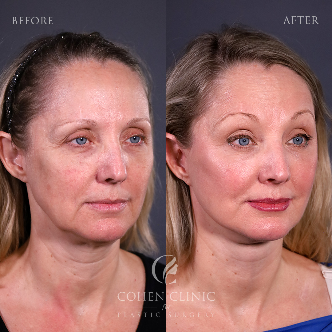 Case 67779 Marge Image