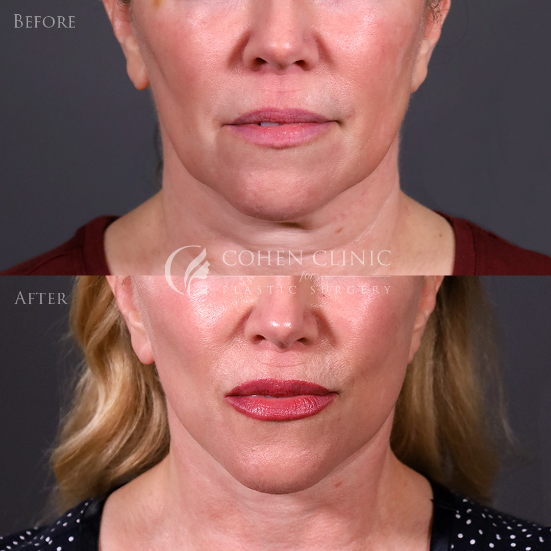 Case 22245 Marge Image