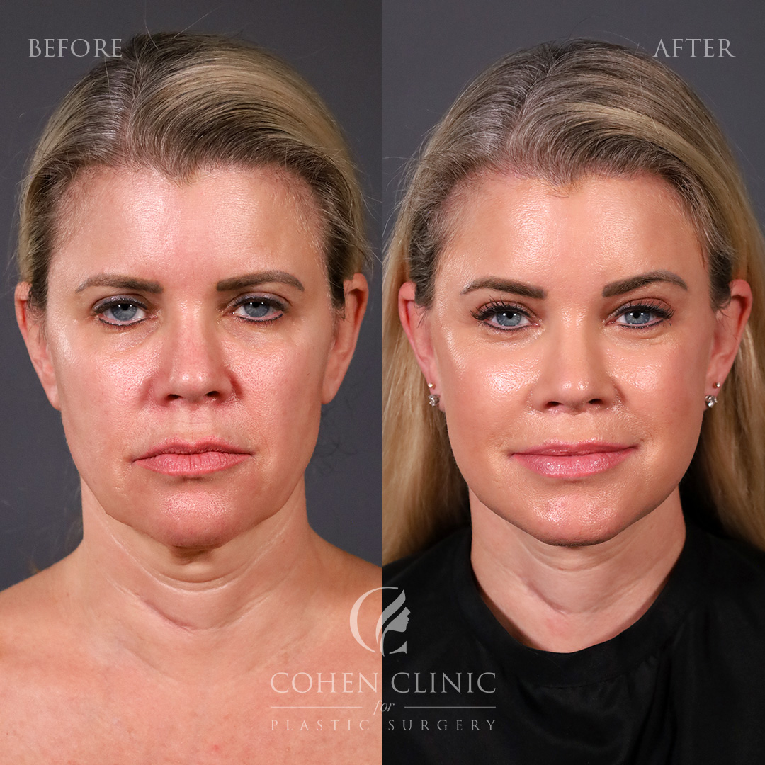 Case 33378 Marge Image