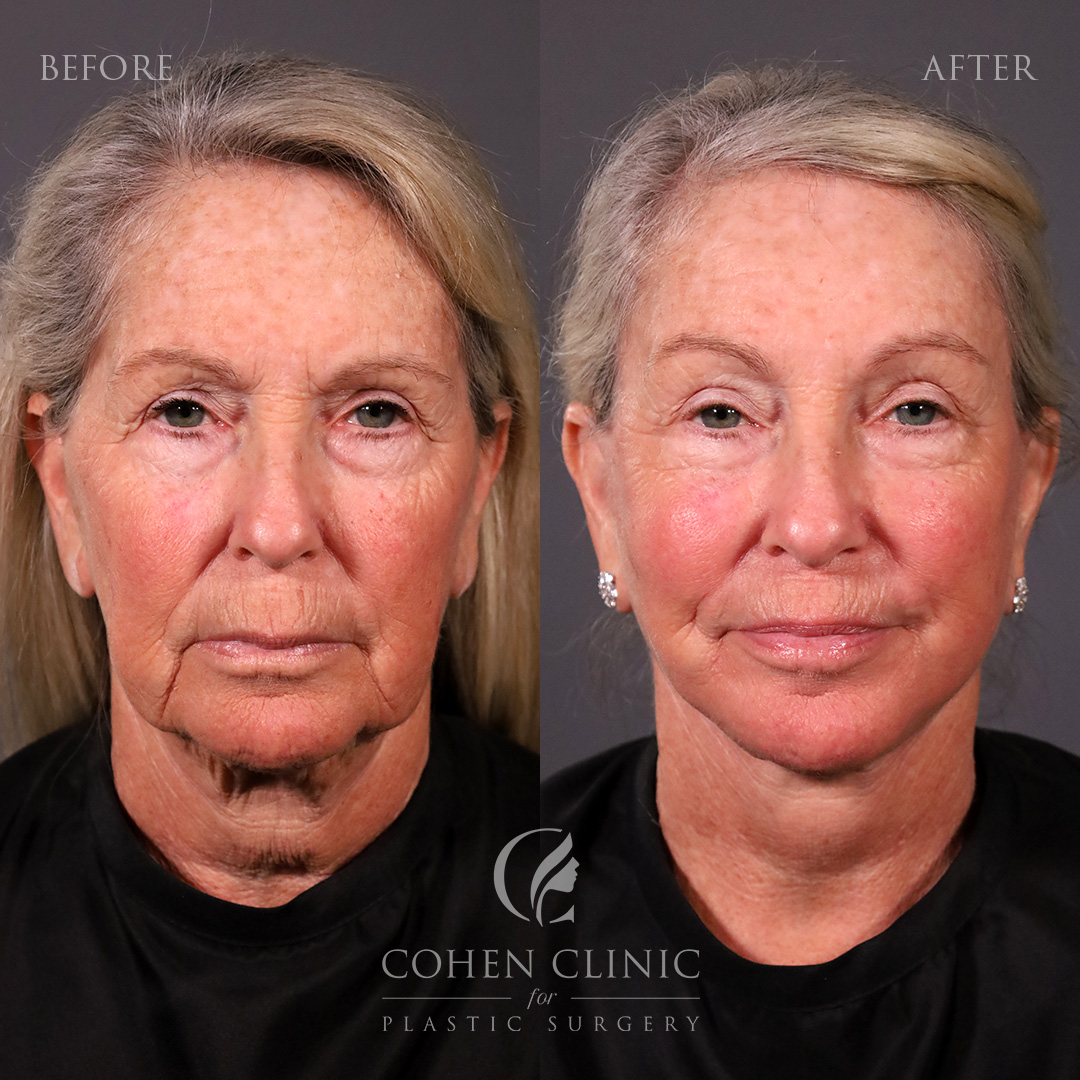 Case 11255 Marge Image