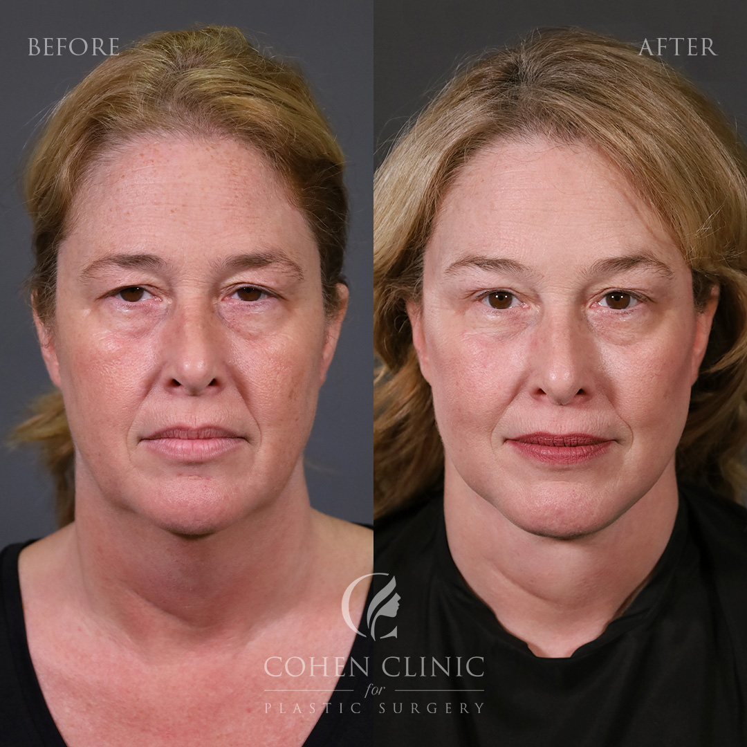 Case 18887 Marge Image