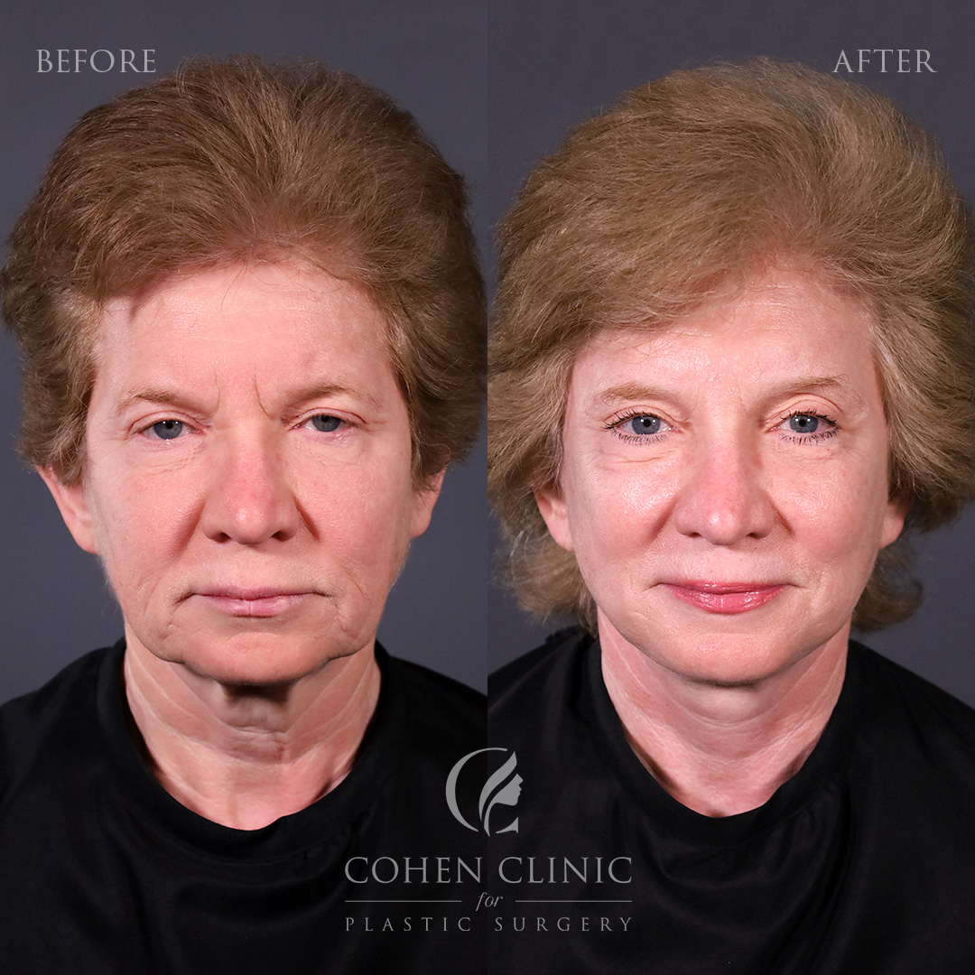 Case 23488 Marge Image