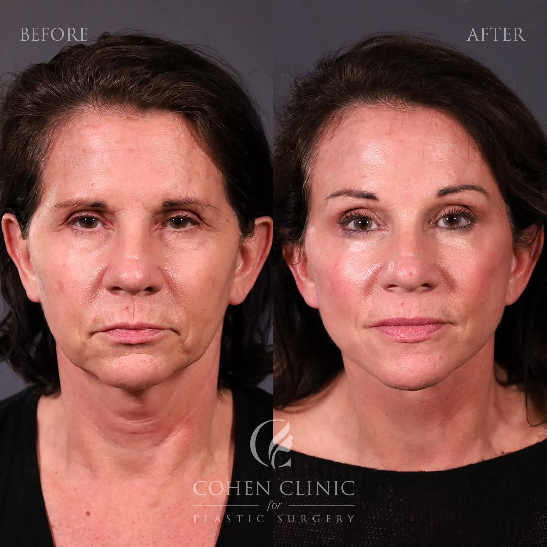 Case 76229 Marge Image