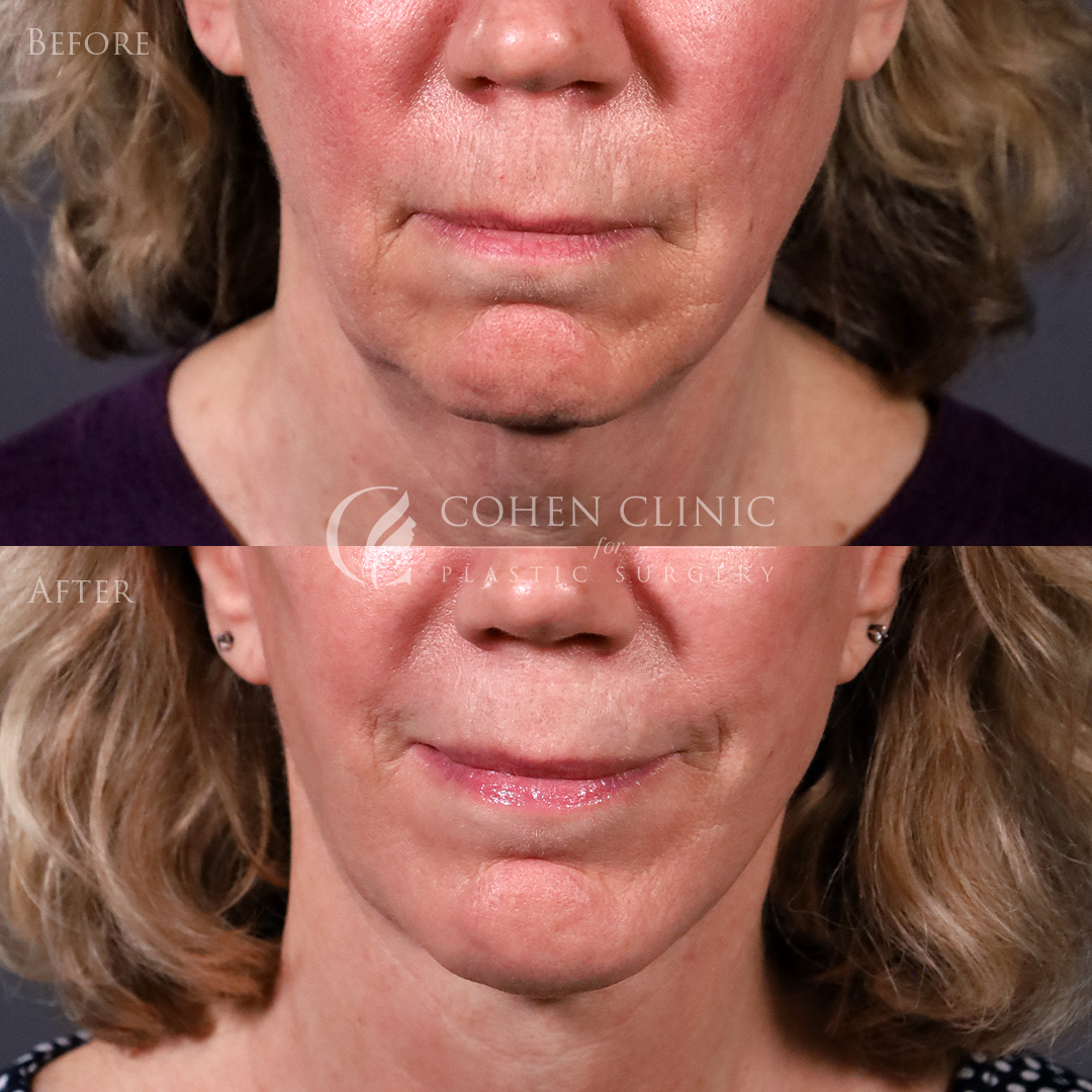 Case 00998 Marge Image