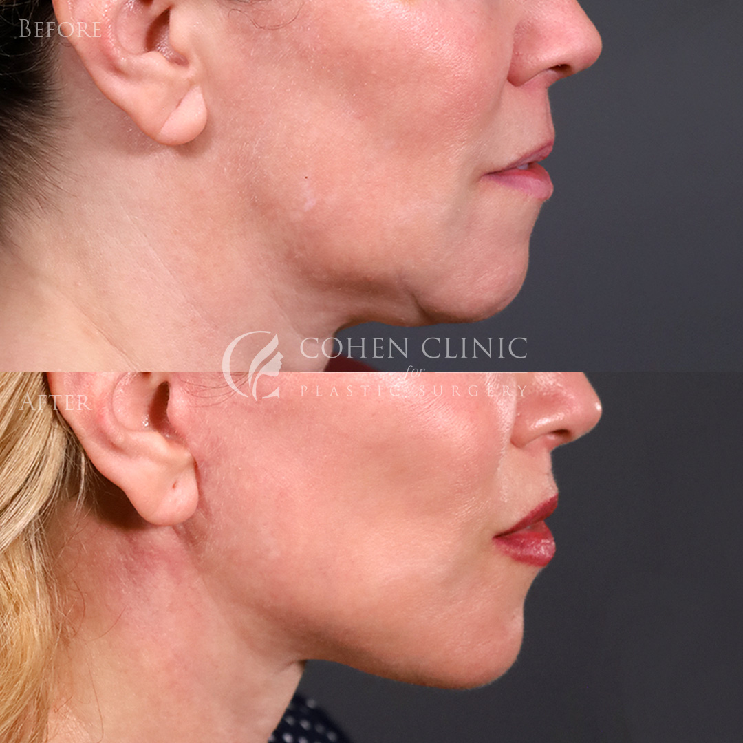 Case 22245 Marge Image